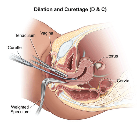 Graphic for Dilation and Curetage