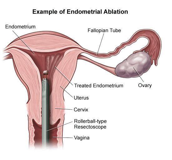 Endometrial Ablation