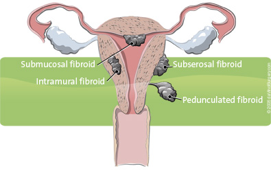 Picture of fibroids