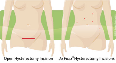 daVinci Hysterectomy Incision and open Hysterectomy Incision comparison