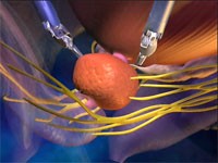 prostate with robotic arms