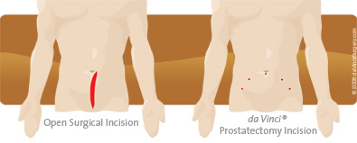prostatectomy incision and open surgical incision comparison