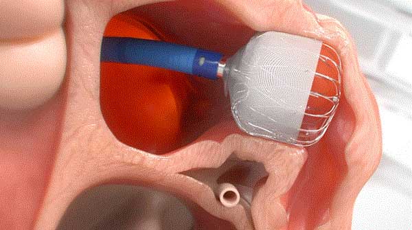 Device Alternative to blood thinners